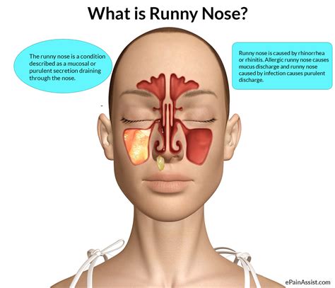 Q and A on Runny Nose or Rhinorrhea: Is It Allergy? Causes of Nasal ...