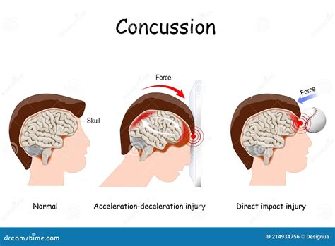 Concussion in Sport. Mild Traumatic Brain Injury Stock Vector ...