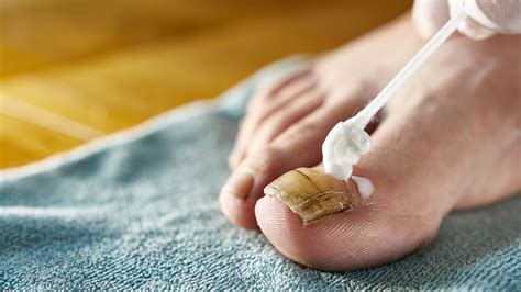 Psoriasis Nails vs. Fungus: Pictures and Differences to Look For - GoodRx