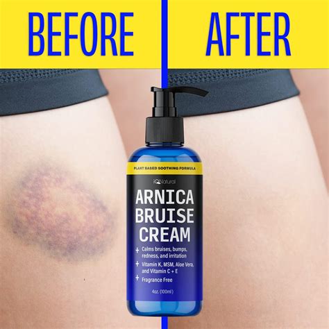 iQ Natural Arnica Cream - Extra Strength Bruise Gel for Fast Healing ...