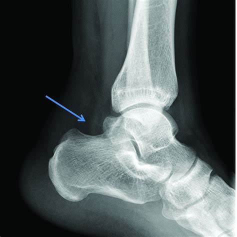 Achilles Tendon Tear X Ray
