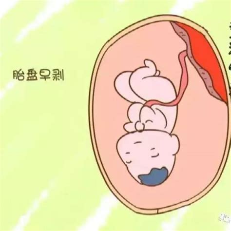怀孕四个月的孕妇，突然肚子痛到休克！危急，医生立即和时间展开赛跑……这是怎么回事呢？
