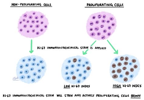 Ki-67標識指数とは？ – MyPathologyReport