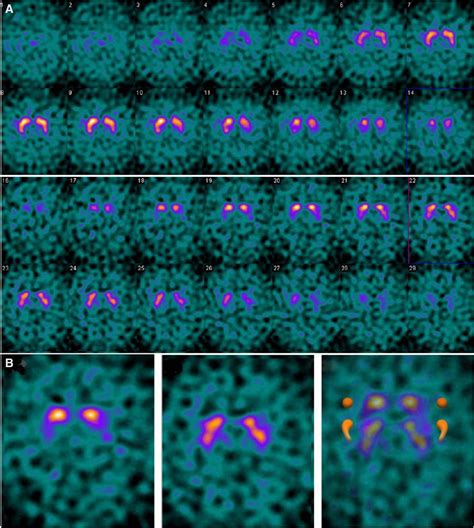 DaTQUANT: The Future of Diagnosing Parkinson Disease | Journal of Nuclear Medicine Technology