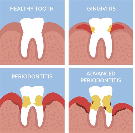 Periodontitis Vs Gingivitis