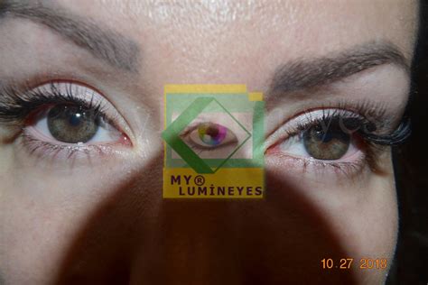 Image result for Eye Color Surgery