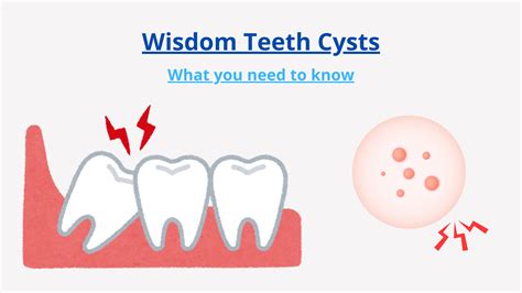 Wisdom Tooth Cyst Removal 的图像结果