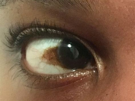 How to get rid of a brown spot / discolouration on the whites of the eye / sclera