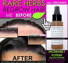 Best Hair Regrowth Shoo For by Organic Hair Regrowth Treatment Hair Loss Best Hair Regrowth Shoo For