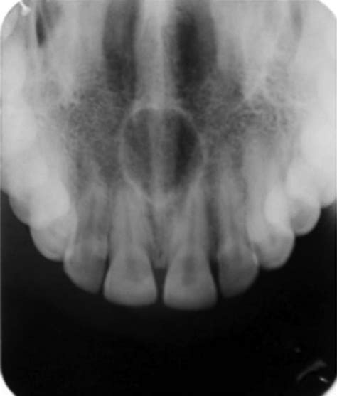 Nasopalatine canal cyst: often missed | BMJ Case Reports
