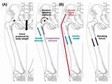 Biomechanical Study of Proximal Femur for Designing Stems for Total Hip ...