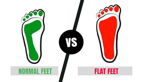 Is Having Flat Feet Normal at Kaitlyn Fitzhardinge blog