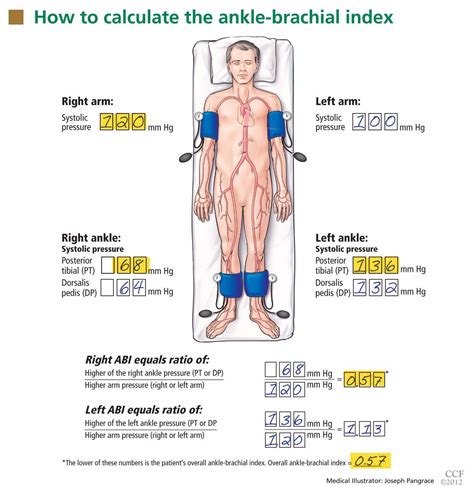Ankle-Brachial Index Procedures Using Unit IX 的图像结果