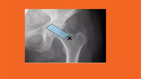 How to Perform Hip Ultrasound 的图像结果