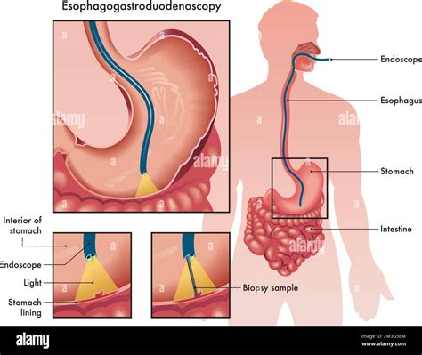 Medical illustration of an Esophagogastroduodenoscopy with two details ...