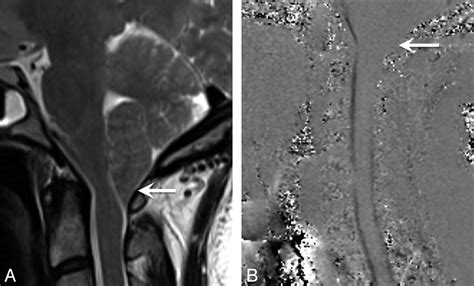Incidence of Cerebellar Tonsillar Ectopia in Idiopathic Intracranial Hypertension: A Mimic of ...