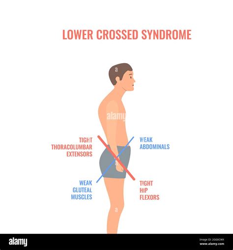 Lower crossed syndrome, conceptual illustration Stock Photo - Alamy