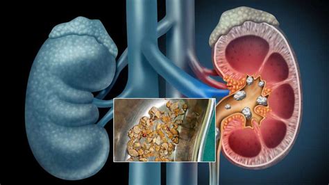 Kidney Stones: కిడ్నీలో 206రాళ్లను తొలగించిన డాక్టర్లు.. ఒక గంటలోనే ...