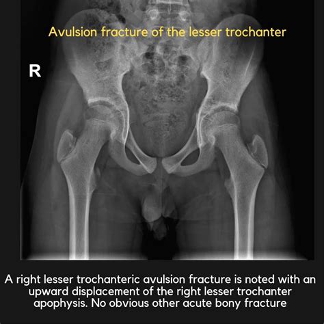 Lesser Trochanter Avulsion