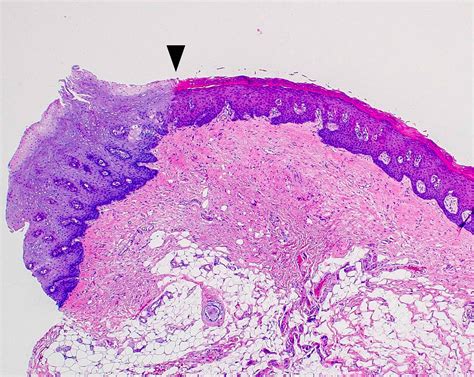 Proliferative Verrucous Leukoplakia Histology Demystifying Oral