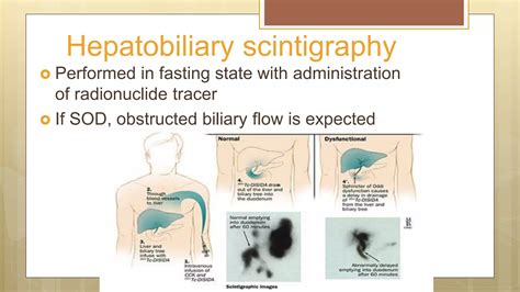 Sods sphincter of Oddi Dysfunction | PPTX