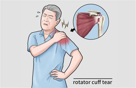 Rotator Cuff Injuries Can Be Devastating, Here Are 5 Best Exercises To Keep Your Shoulders Healthy