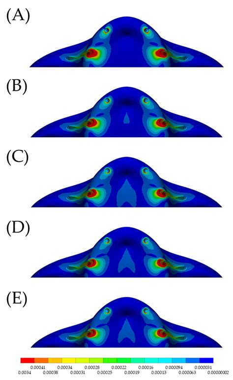Stress Distribution Pattern in Zygomatic Implants Supporting Different ...