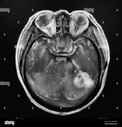 Blood Test Show Brain Cancer at Vanessa Najera blog