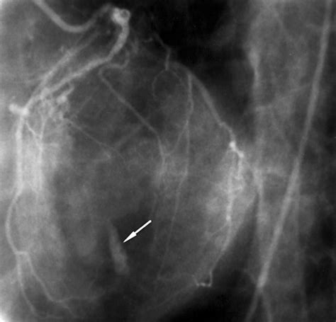 Papillary muscle calcification after inferoposterior myocardial ...