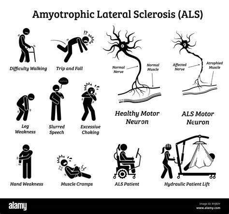 The Stages Of Amyotrophic Lateral Sclerosis (ALS) ALS News, 47% OFF