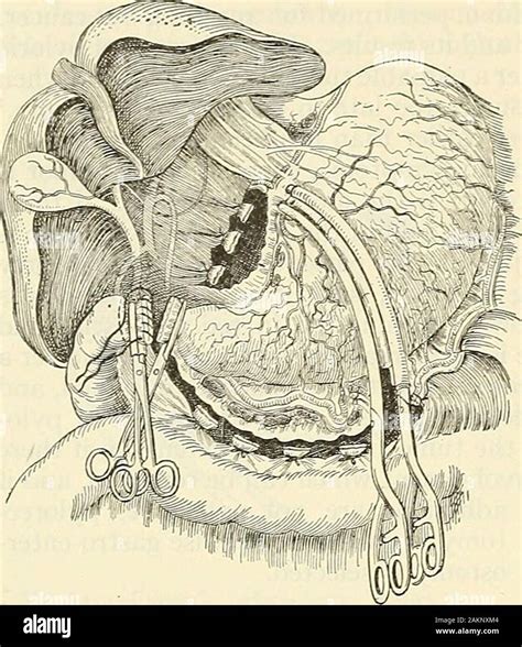 Billroth Surgery Intracorporeal Hemi Hand Sewn Technique For