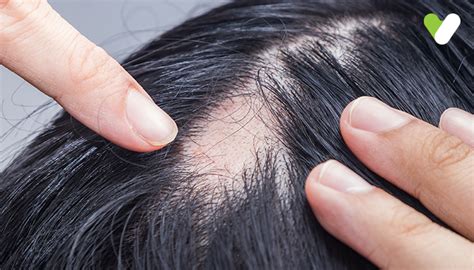 Folliculitis Decalvans: Symptoms & Chronic Treatment