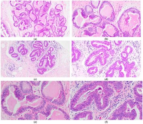 Columnar Cell Lesions | Encyclopedia MDPI