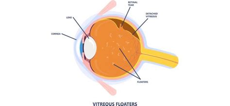 Image result for Eye Floaters Under Microscope