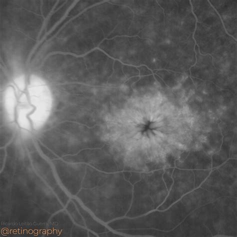 Cystoid Macular Edema – Retinography