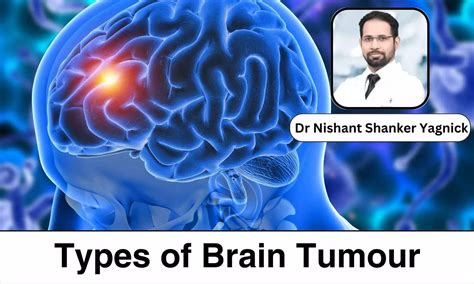 World Brain Tumour Day 2024: What are the different types of Brain ...