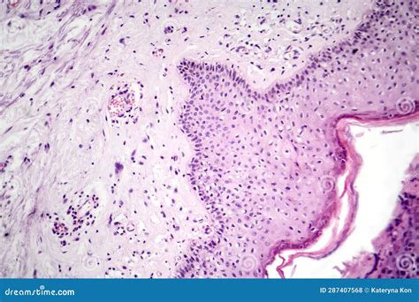 Basal Cell Carcinoma, Light Micrograph Stock Photography | CartoonDealer.com #287407568