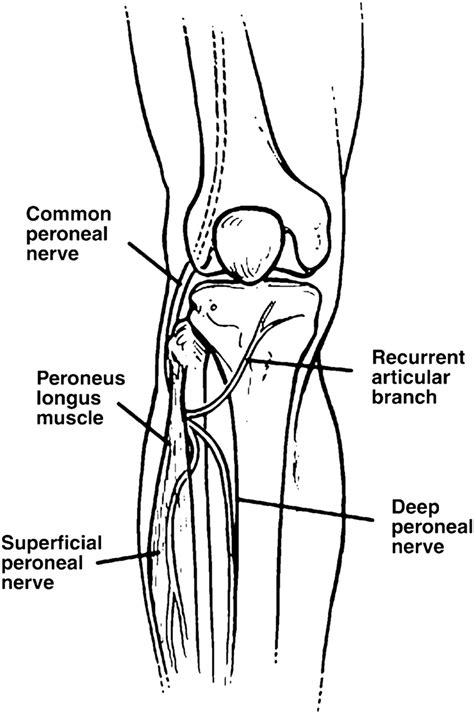 Entrapment Of The Peroneal Nerve