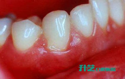 平时要怎么预防牙龈炎呢？ | 升艺口腔医院