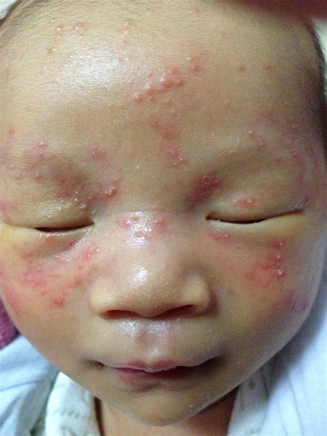 婴儿红苹果脸的原因是什么 如何护理红脸宝宝？ - 知乎