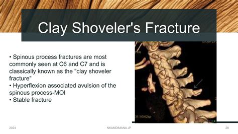 SUBAXIAL SPINE INJURY BY DR NKUNDIMANA JEAN PAUL .pptx