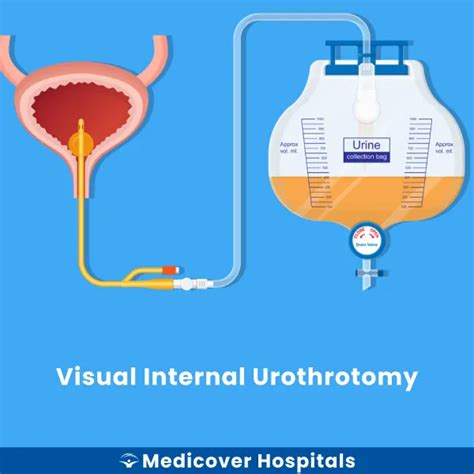 Visual Internal Urethrotomy (VIU) Surgery: Expert Urologists & Urethral ...