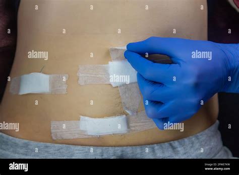 Image result for Appendix Surgery Scar