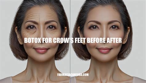 Botox for Crow's Feet: Before & After Effects, Treatment, and Results