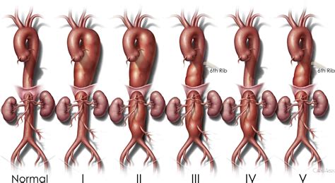 Thoracic Aortic Aneurysm Aortic Aneurysm Aneurysm Tho - vrogue.co
