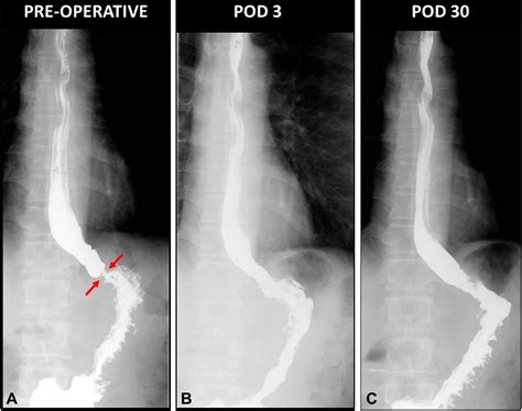 Endoscopic mucoplasty for benign esophageal strictures (multiple ...