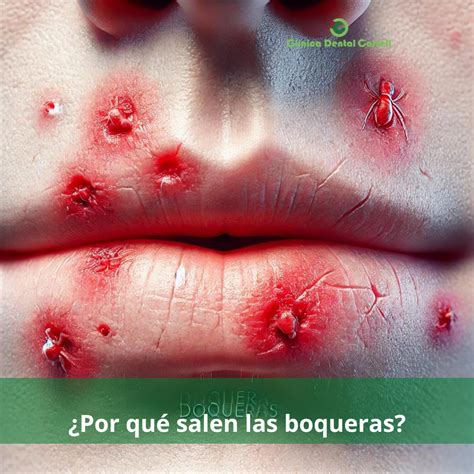 ¿Por qué salen las boqueras? - Clínica Castell