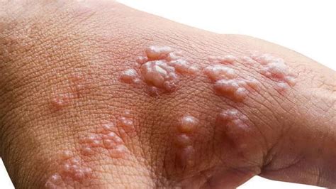 Arrives in Kerala with symptoms of monkeypox; after confirmed of ...