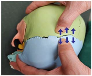 Development of a Cranial Suture Traction Therapy Program for Facial ...
