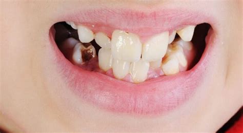 Image result for Discolored Tooth
